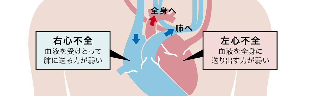 心不全イメージ