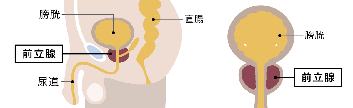 前立腺炎イメージ