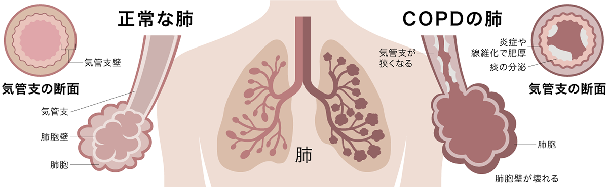 慢性閉塞性肺疾患(COPD)イメージ