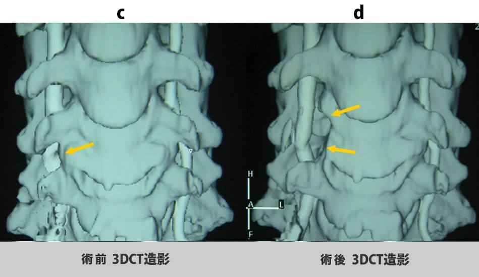 術前3DCT造影と術後3DCT造影
