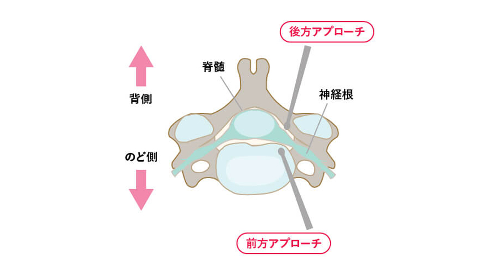 前方アプローチと後方アプローチ