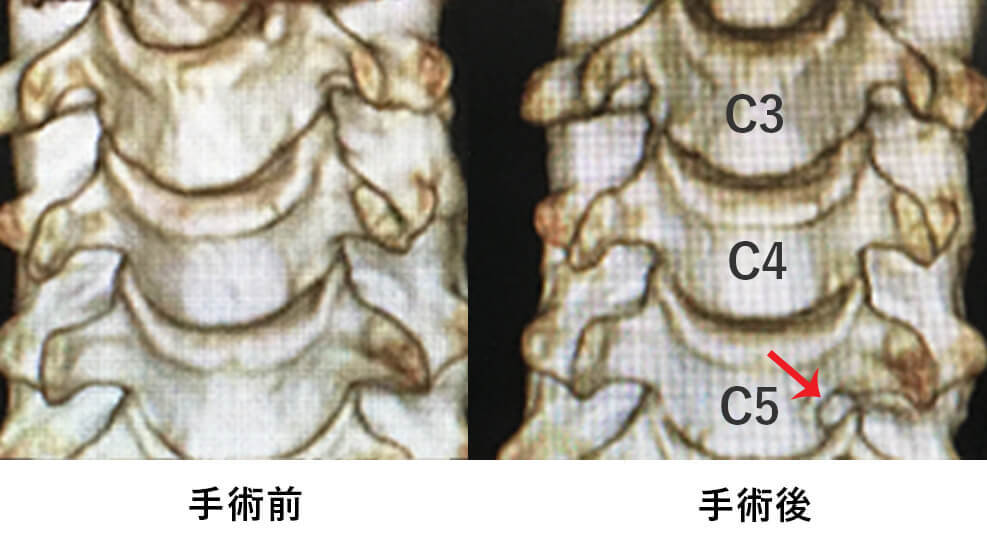頚椎3DCT