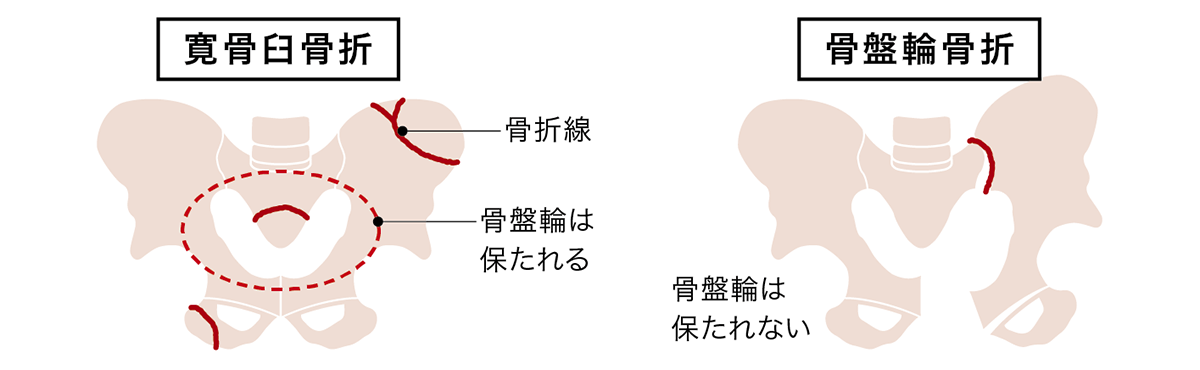 骨盤外傷