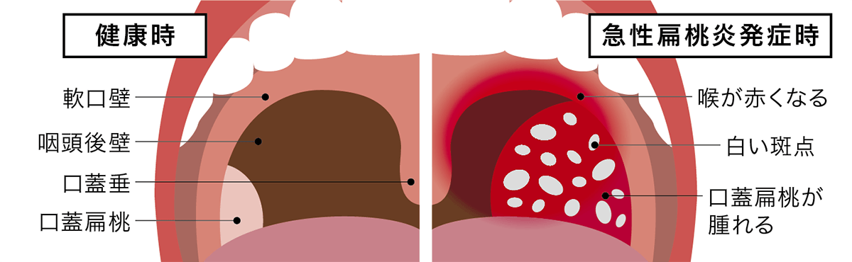 喉 に つっかえる 感じ