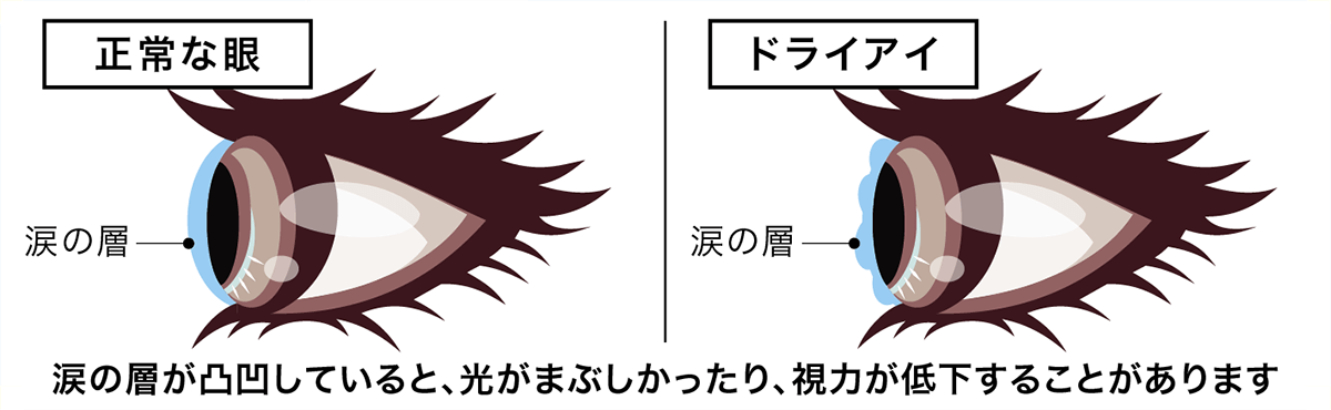 ドライアイ