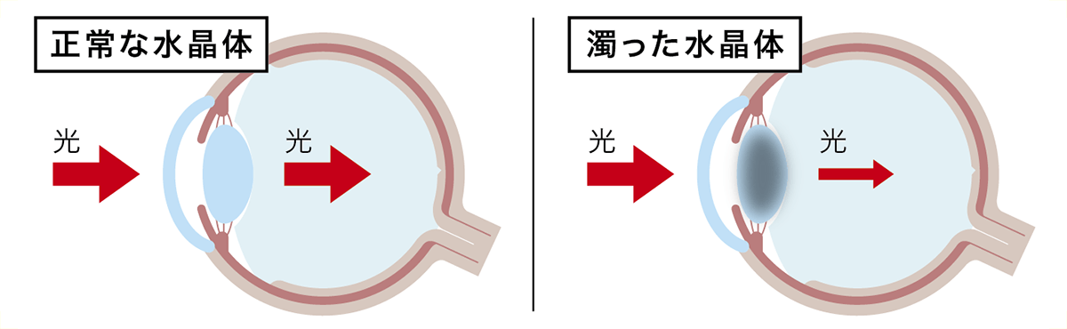 白内障