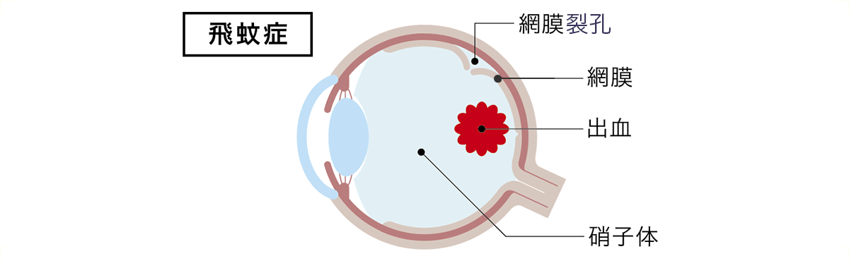 飛蚊症