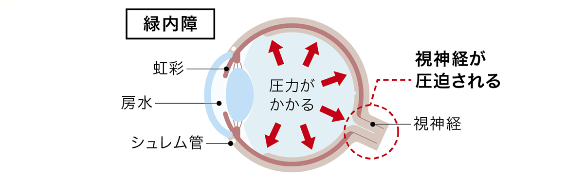 緑内障