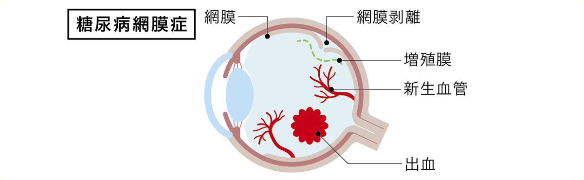 糖尿病網膜症