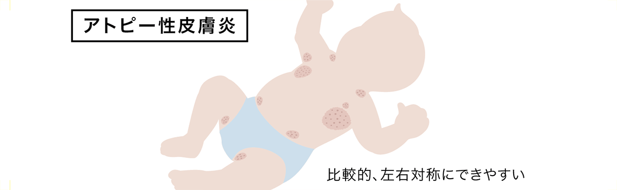 アトピー性皮膚炎