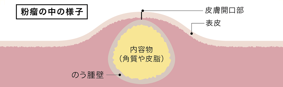 皮膚腫瘍イメージ