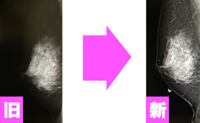 マンモグラフィ3