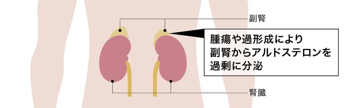 原発性アルドステロン症