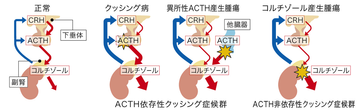 クッシング症候群