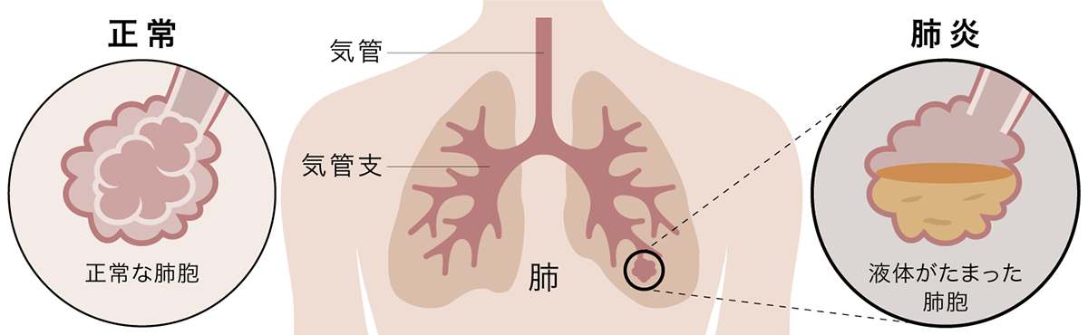 肺炎イメージ