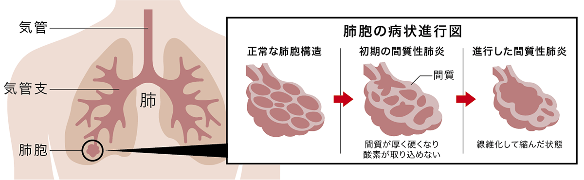 肺線維症(間質性肺炎)イメージ