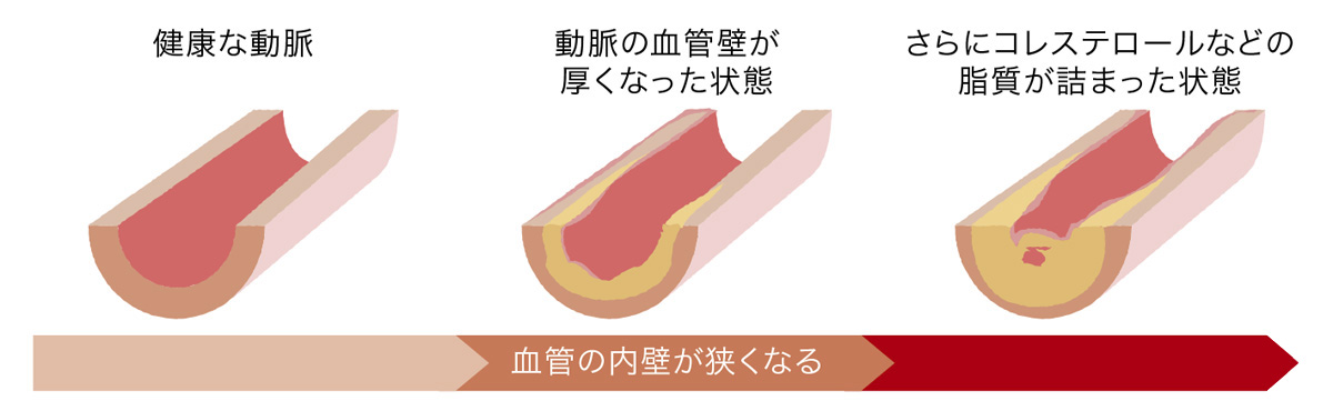 脂質異常症