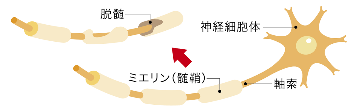 多発性硬化症イメージ