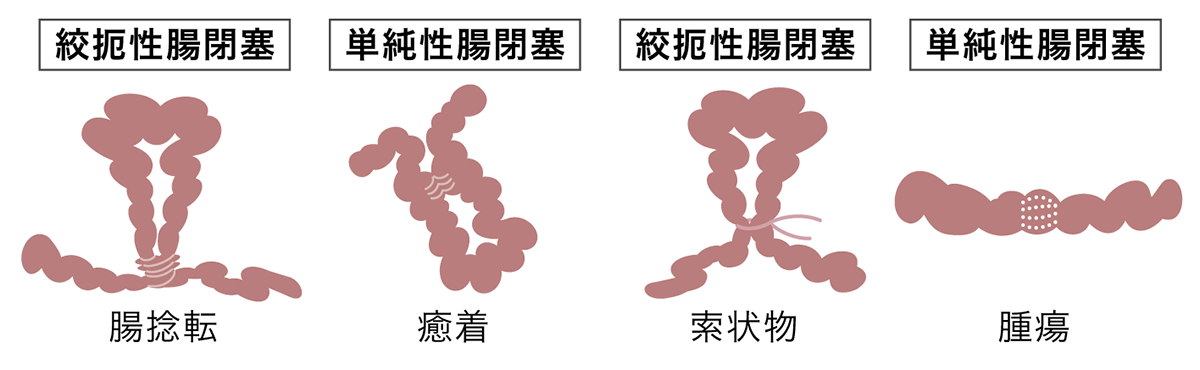 腸閉塞