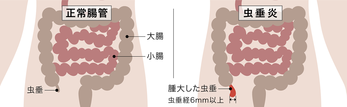 急性虫垂炎