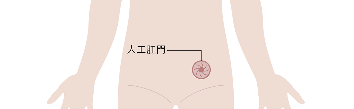 人工肛門