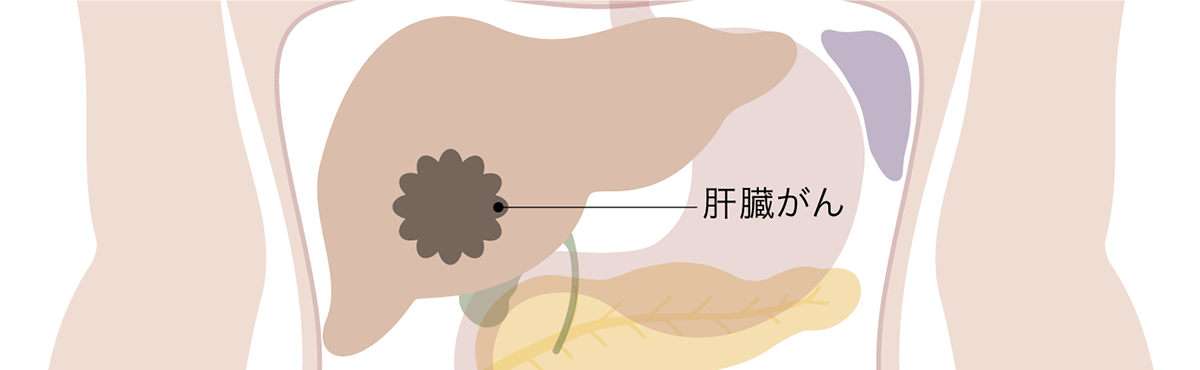 肝臓がん