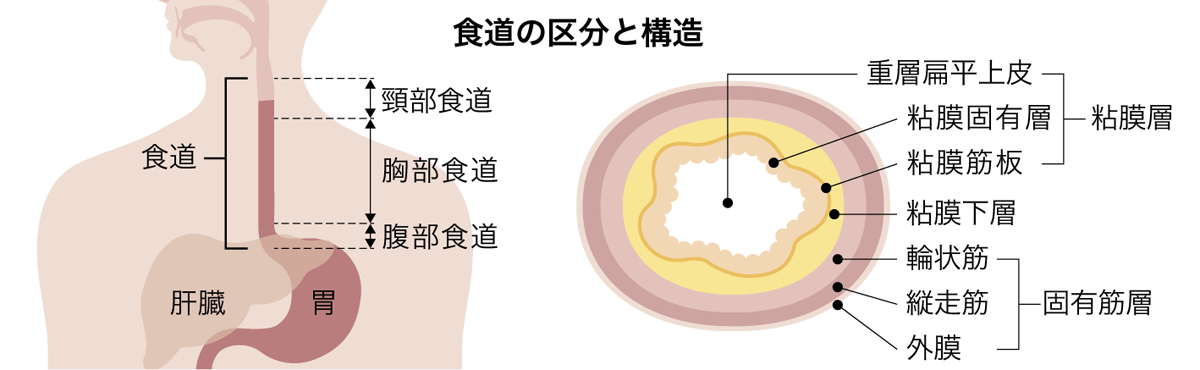 食道がんイメージ