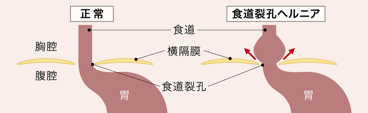 食道裂孔ヘルニア