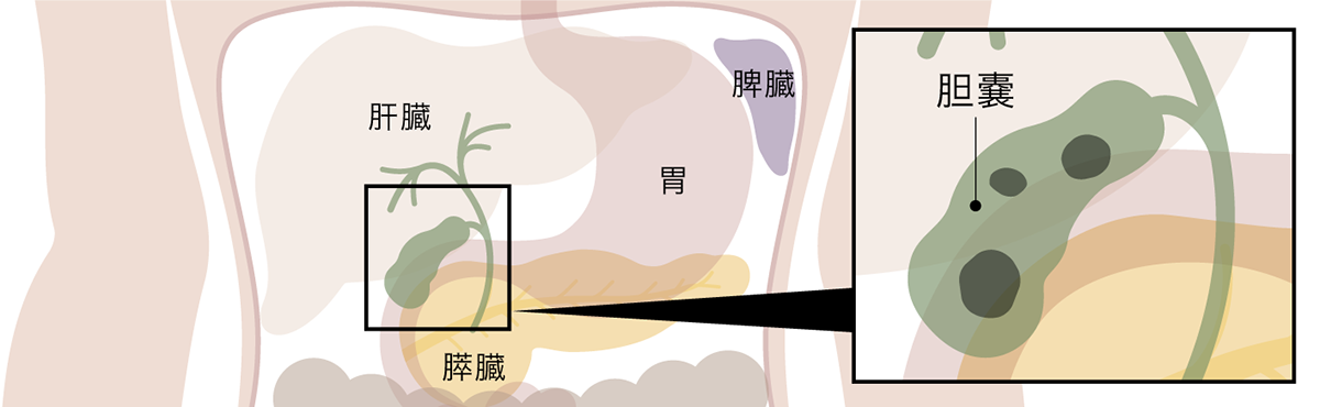 急性胆のう炎