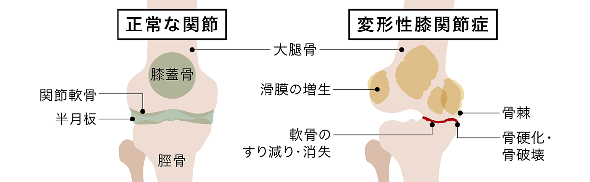 変形性関節症