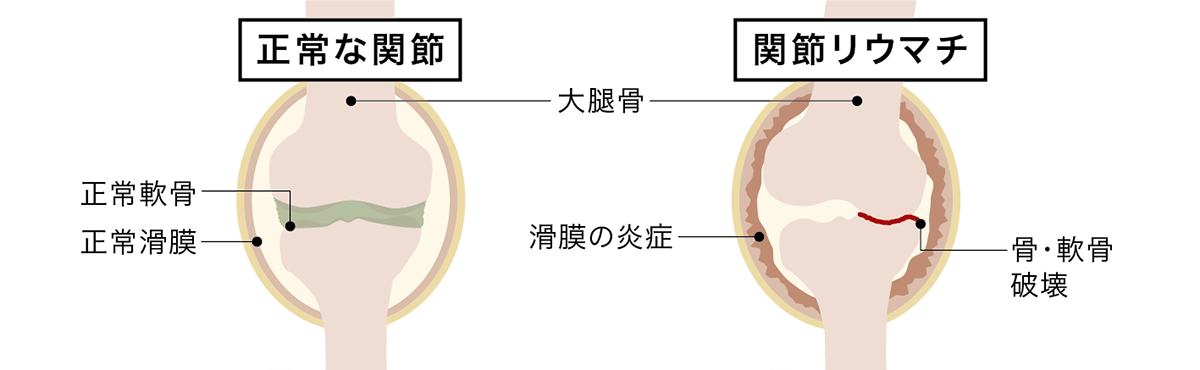 リウマチ性疾患