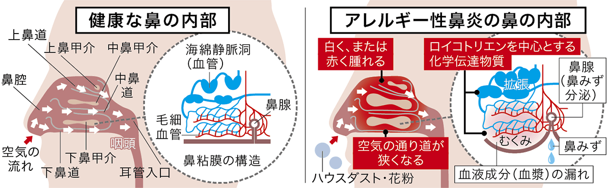 アレルギー性鼻炎イメージ