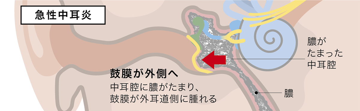 急性中耳炎イメージ