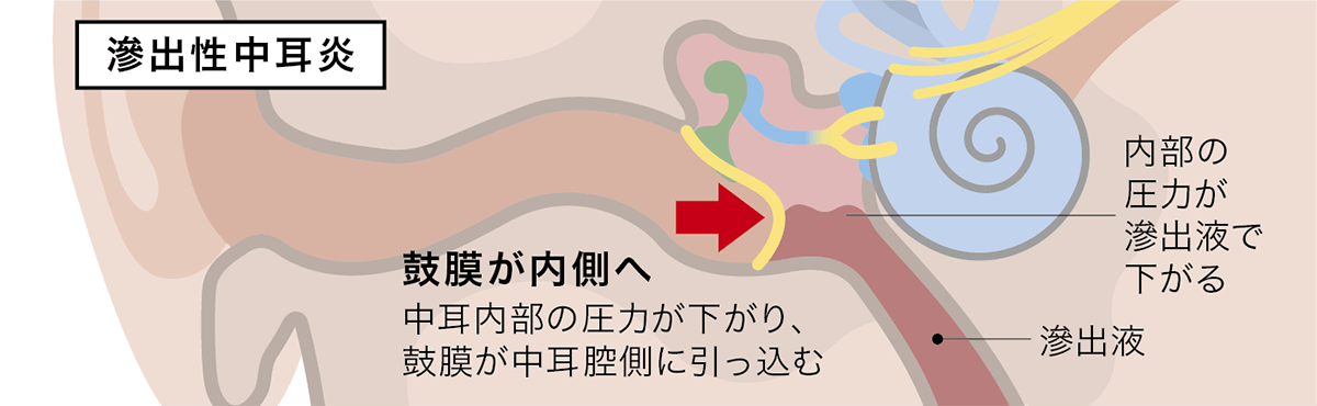 滲出性中耳炎イメージ