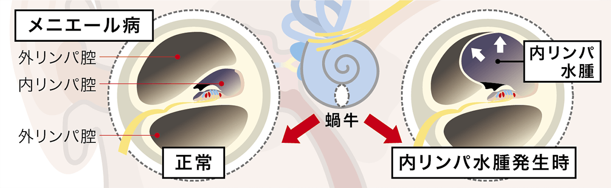 メニエール病
