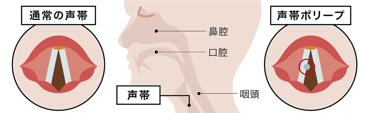 声帯ポリープイメージ