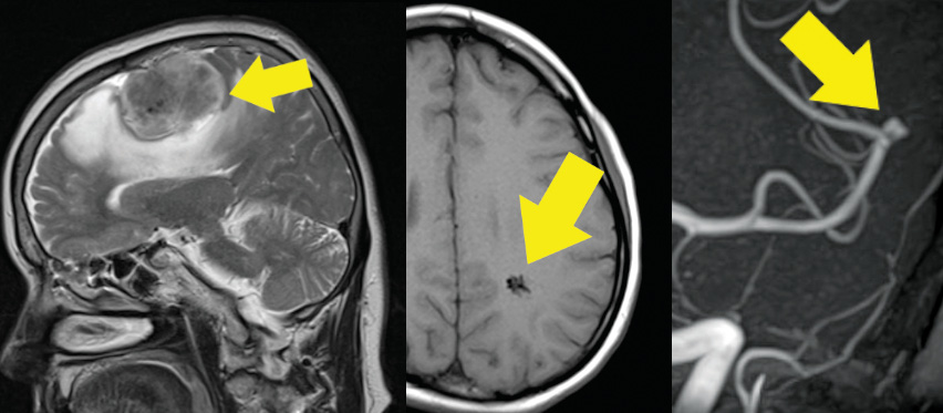 頭部MRI・MRA