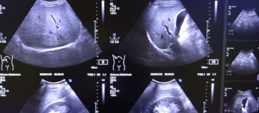 腹部エコー